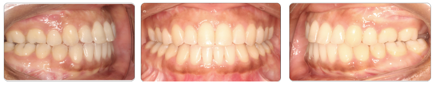 class-iii-surgical-after