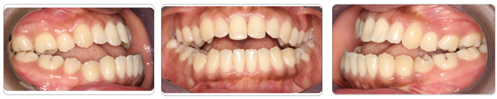 class-iii-surgical-before