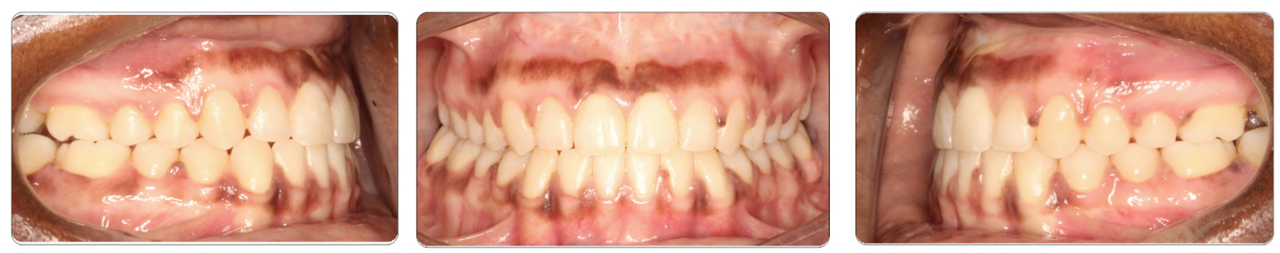 skeletal-open-bite-after