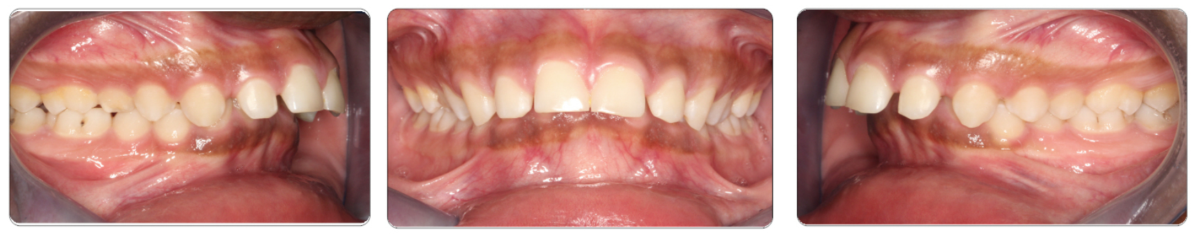 Deep Bite Proclined Before