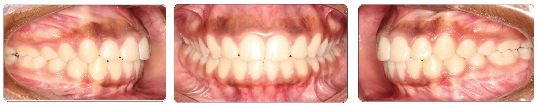 Mothupi Class II Surgical After