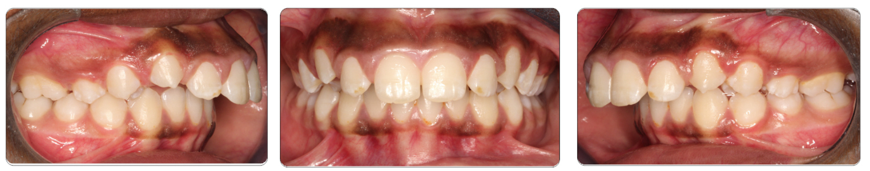 Mothupi Class II Surgical Before