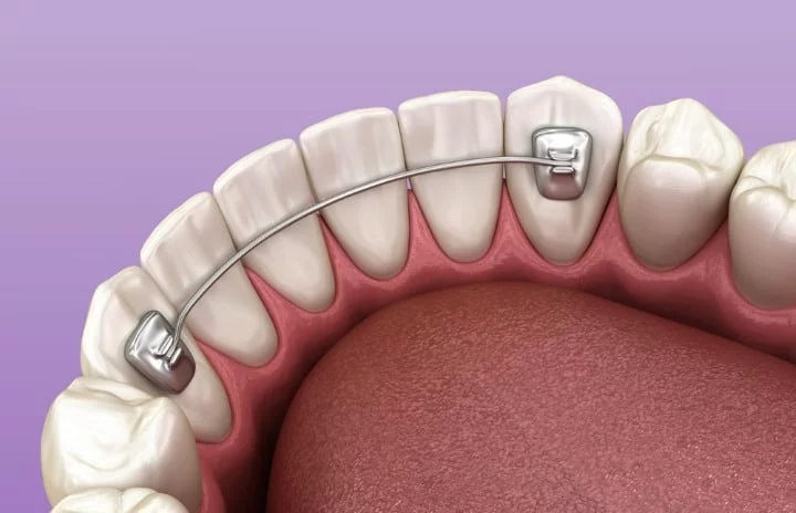 bonded-teeth-retainers-one-wire