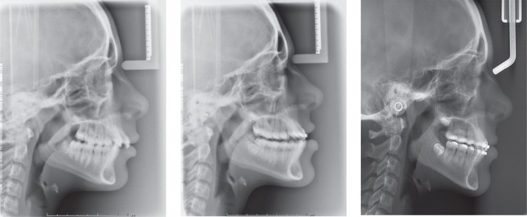 lateral