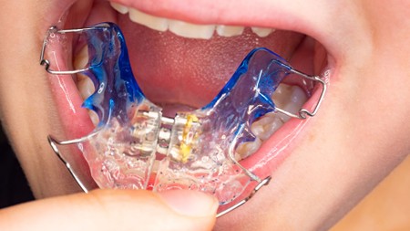 palatal-expander