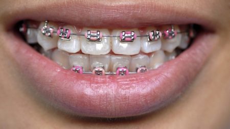 coloured-metal-braces