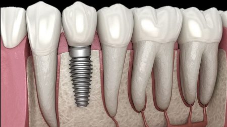 implants