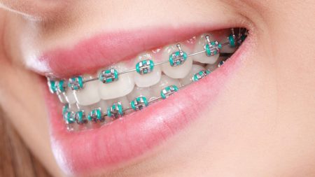 metal-braces